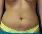 Feel Beautiful - Liposuction abdomen - After Photo